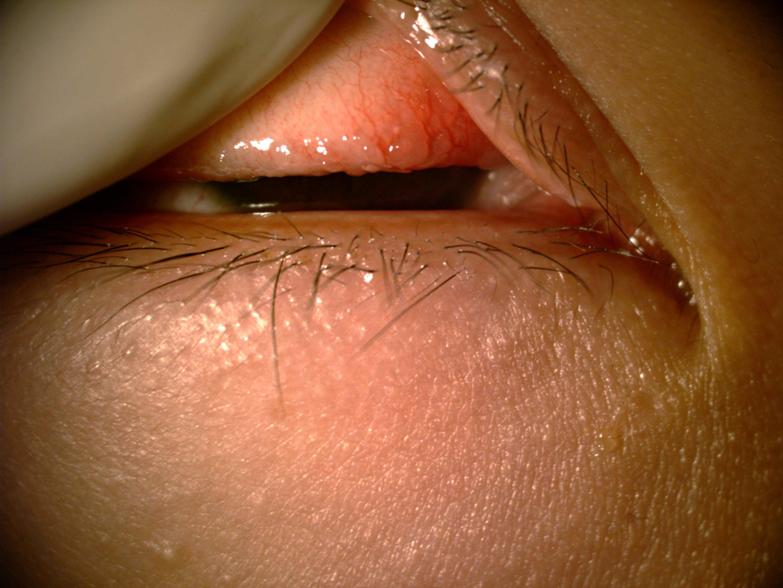 Allergic Eye Disease