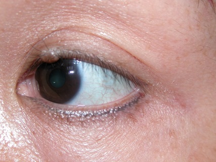 Lumps and bumps on the eyelids - Non infection types/tumours